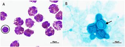 Case Report: Cryptococcal eosinophilic meningitis in a patient with Hodgkin lymphoma